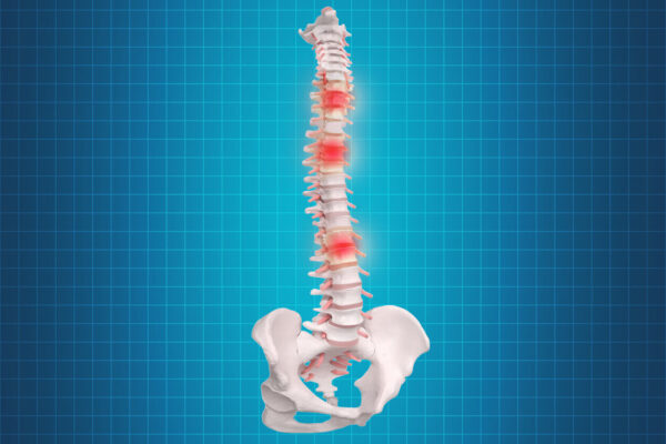 Spinal Disc Replacement