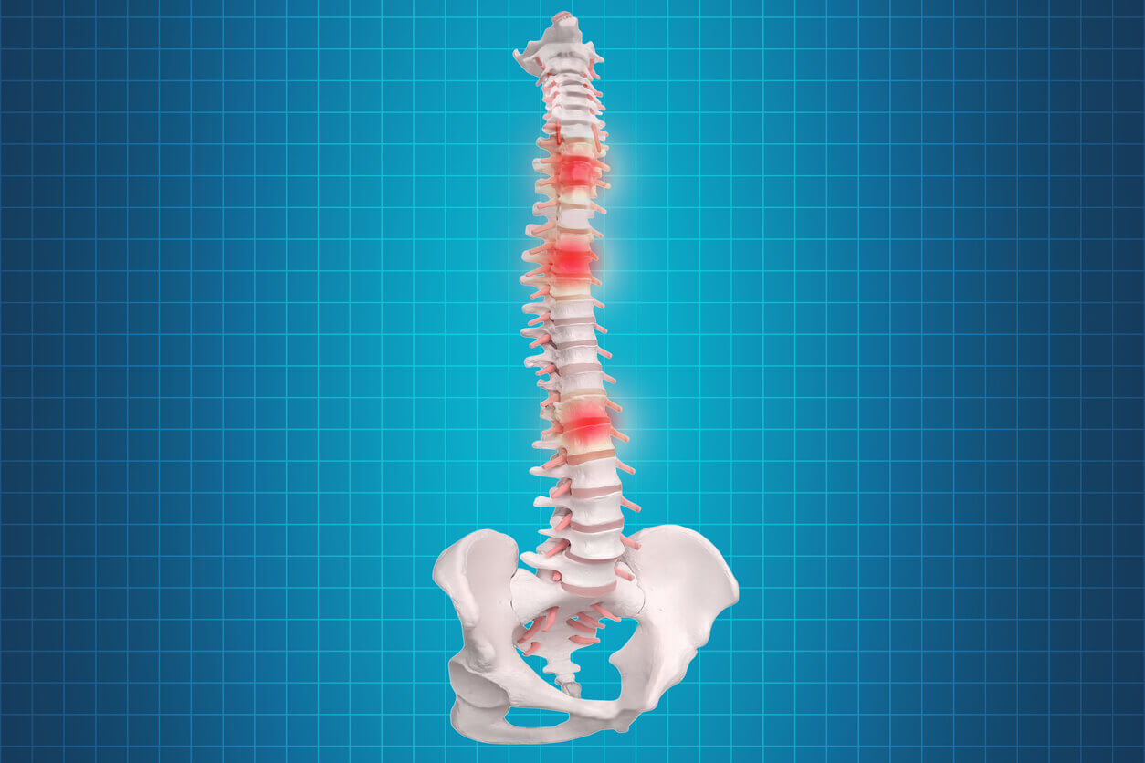 Spinal Disc Replacement